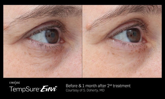 Tempsure Envi before and after