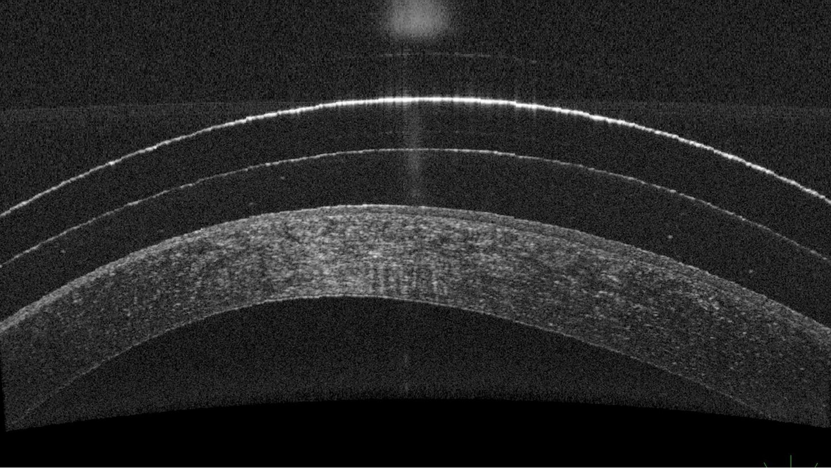 OCT scan showing distorted cornea in keratoconus